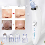 Derma  Blackhead Remover Device